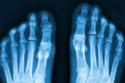 Foot x-ray